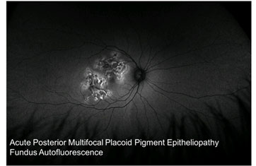 Acute Posterior Multifocal Placoid Pigment Epitheliopathy Fundus Auto fluorescence