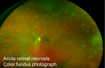 Acute Retinal Necrosis Fundus photograph