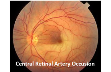 Central Retinal Artery Occlusion Fundus photograph