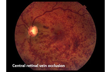 Central-Retinal-Vein-Occlusion
