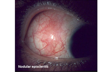 Nodular Episcleritis