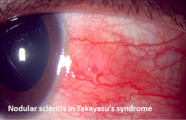 Nodular Scleritis in Takayasu’s Syndrome