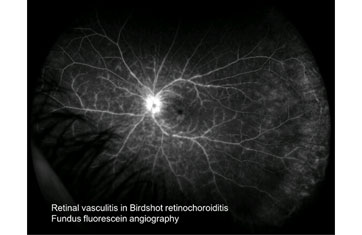 Retinal Vasculitis in Birdshot Retinochoroiditis  Fundus fluorescein angiography