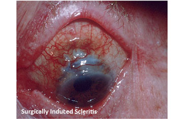Surgically induced Scleritis